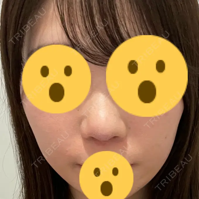 軟骨移植 / 鼻尖縮小 みずほクリニック DAY 9 メイン用