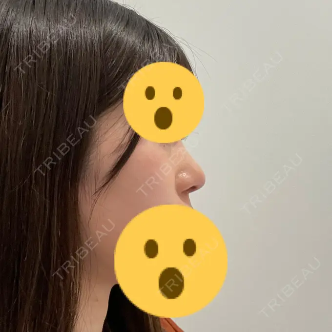 軟骨移植 / 鼻尖縮小 みずほクリニック DAY 9 メイン用