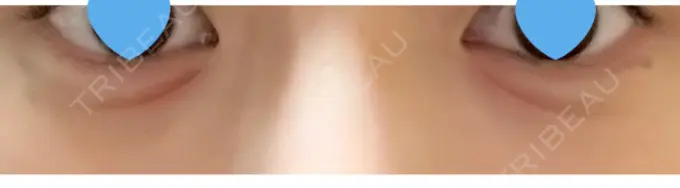 ヒアルロン酸注入（涙袋） フィラークリニック 町田院 DAY 0 メイン用