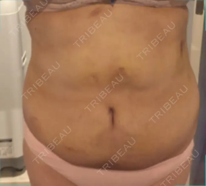 脂肪吸引（お腹） / インディバ（お腹） 藤・ナチュレ美容クリニック 恵比寿院 DAY 14 メイン用