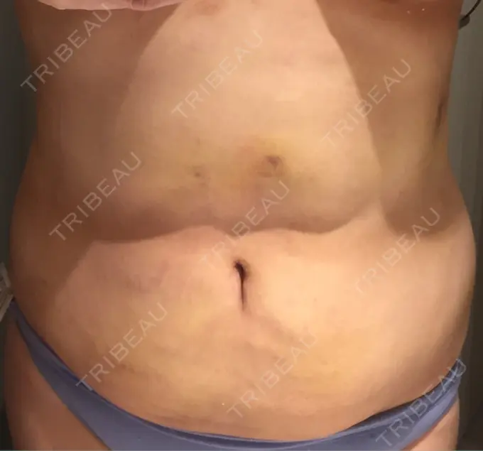 脂肪吸引（お腹） / インディバ（お腹） 藤・ナチュレ美容クリニック 恵比寿院 DAY 15 メイン用
