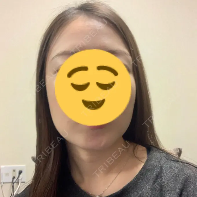 糸リフト / 脂肪吸引（顔） / メーラーファット除去 / ボトックス（エラ・小顔） 湘南美容クリニック 秋葉原院 DAY 22 メイン用