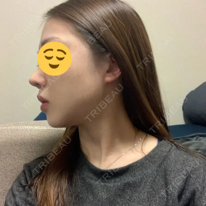 糸リフト / 脂肪吸引（顔） / メーラーファット除去 / ボトックス（エラ・小顔） 湘南美容クリニック 秋葉原院 DAY 22 メイン用