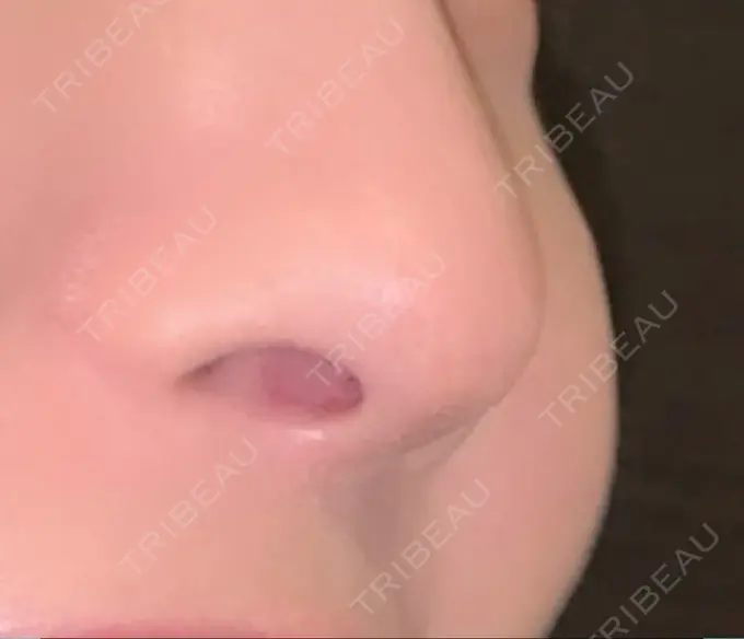 人中短縮 / PRP皮膚再生療法 BIANCA銀座 AFTER メイン用