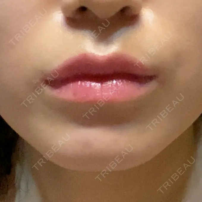 ヒアルロン酸注入（唇） / ボトックス（口角） ルラ美容クリニック 大宮院 / ルラスキンクリニック 大宮院 DAY 12 メイン用