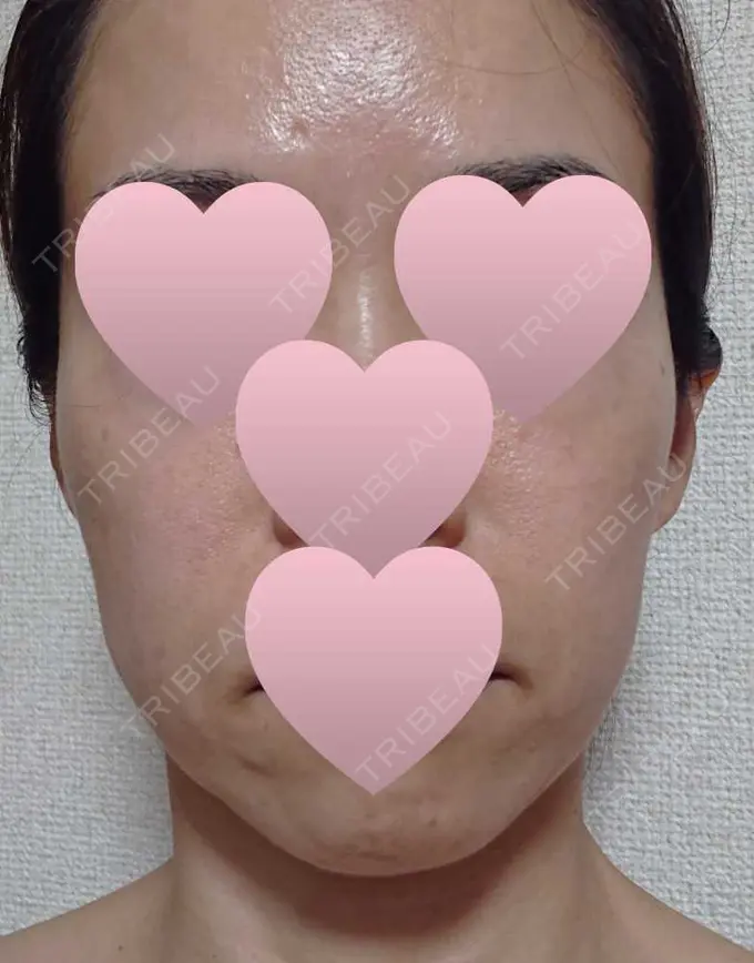 ハイフ（顔） 赤坂プレミアクリニック AFTER メイン用