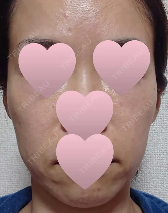 ハイフ（顔） 赤坂プレミアクリニック DAY 1 メイン用