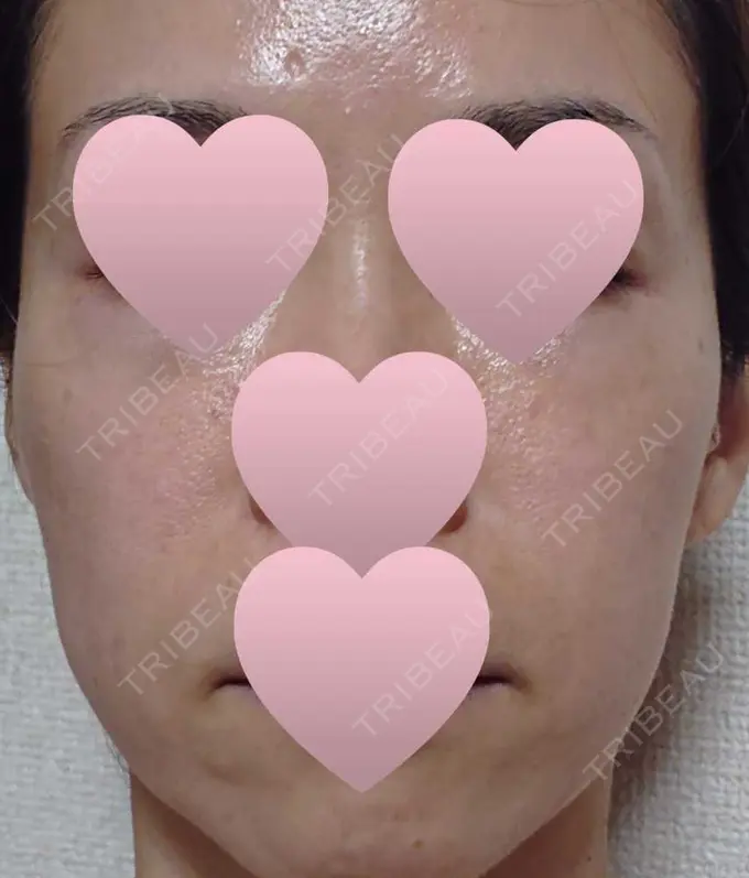 ハイフ（顔） 赤坂プレミアクリニック DAY 0 メイン用