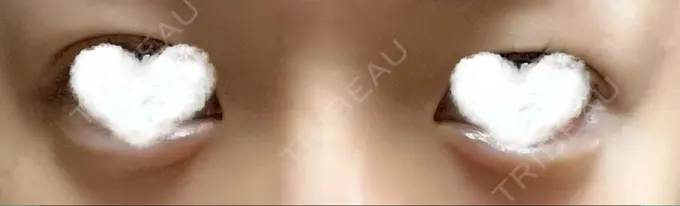 ヒアルロン酸注入（涙袋） フィラークリニック 町田院 DAY 2 メイン用