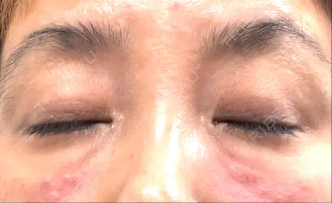 ヒアルロン酸注入（目の下） 渋谷美容外科クリニック 渋谷院 DAY 0 メイン用