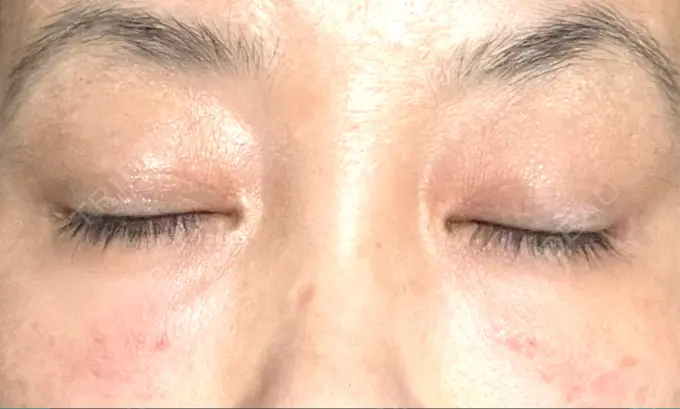 ヒアルロン酸注入（目の下） 渋谷美容外科クリニック 渋谷院 DAY 1 メイン用