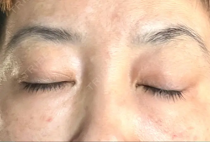 ヒアルロン酸注入（目の下） 渋谷美容外科クリニック 渋谷院 DAY 2 メイン用