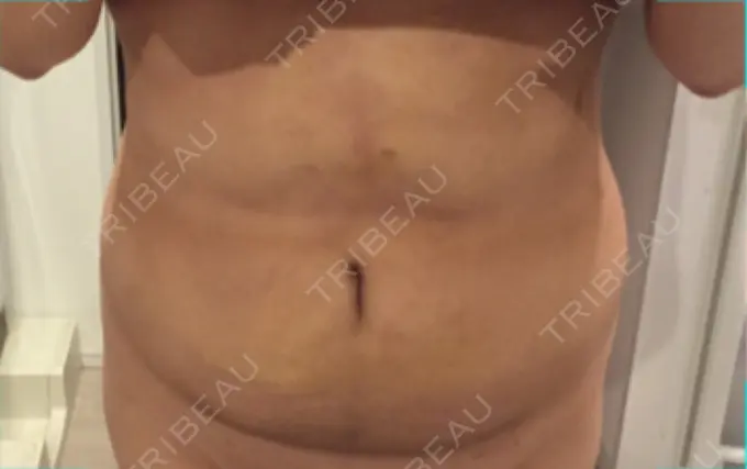 脂肪吸引（お腹） / インディバ（お腹） 藤・ナチュレ美容クリニック 恵比寿院 DAY 21 メイン用