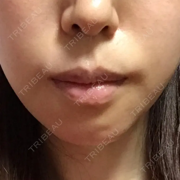 あごプロテーゼ / 骨切り（あご） ジョウクリニック 大阪院 DAY 14 メイン用