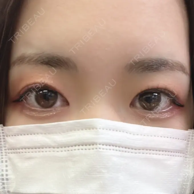 アートメイク（眉） 表参道ウィズ・クリニック DAY 4 メイン用