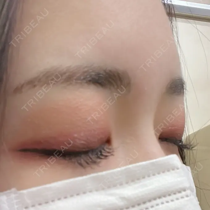 アートメイク（眉） 表参道ウィズ・クリニック DAY 4 メイン用