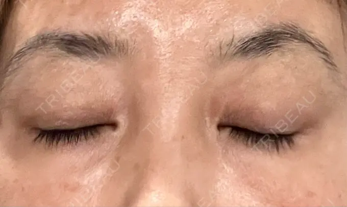 ヒアルロン酸注入（目の下） 渋谷美容外科クリニック 渋谷院 DAY 3 メイン用