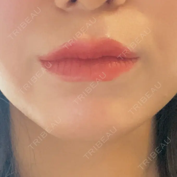 ヒアルロン酸注入（唇） / ボトックス（口角） ルラ美容クリニック 大宮院 / ルラスキンクリニック 大宮院 DAY 18 メイン用