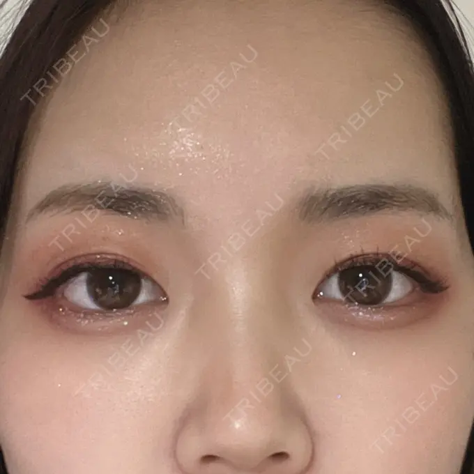 アートメイク（眉） 表参道ウィズ・クリニック DAY 5 メイン用