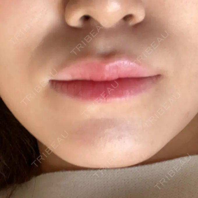 ヒアルロン酸注入（唇） / ボトックス（口角） ルラ美容クリニック 大宮院 / ルラスキンクリニック 大宮院 DAY 19 メイン用