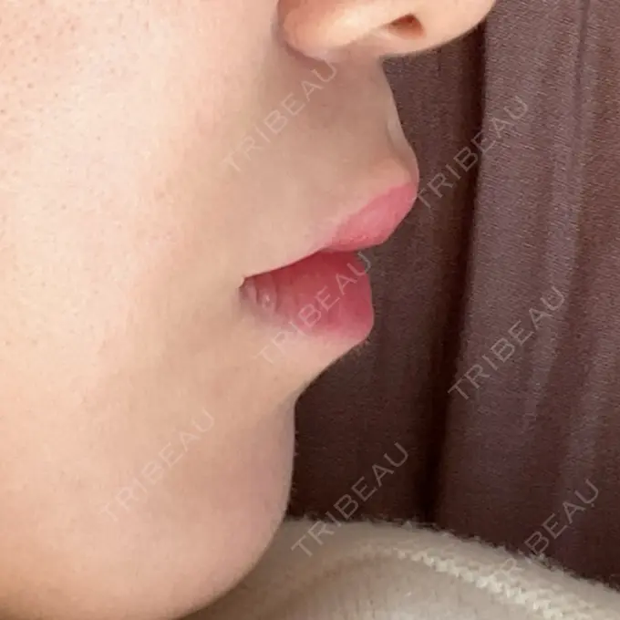 ヒアルロン酸注入（唇） / ボトックス（口角） ルラ美容クリニック 大宮院 / ルラスキンクリニック 大宮院 DAY 19 メイン用