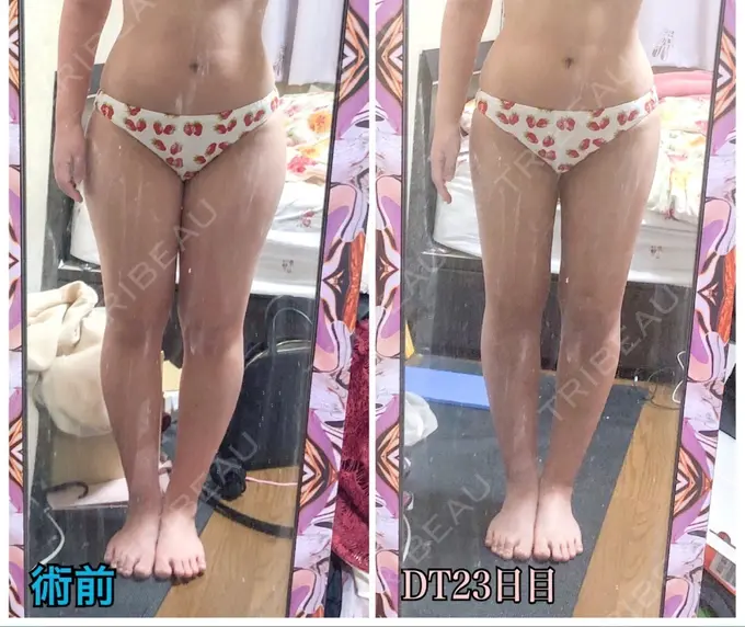 脂肪吸引（脚） / 脂肪吸引（お尻） / ボトックス（ふくらはぎ） ラインカルチャークリニック DAY 22 メイン用