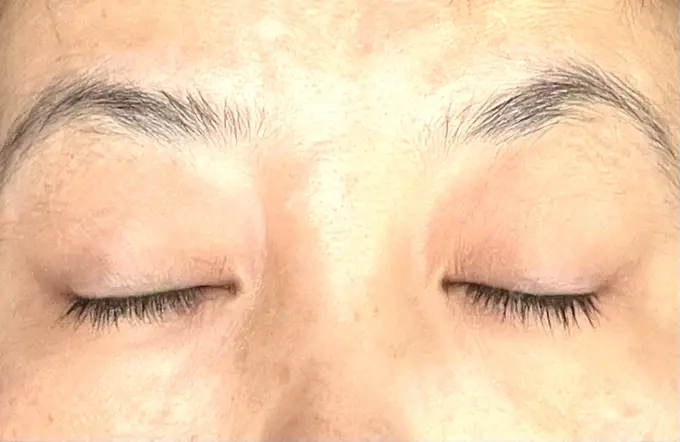 ヒアルロン酸注入（目の下） 渋谷美容外科クリニック 渋谷院 AFTER メイン用