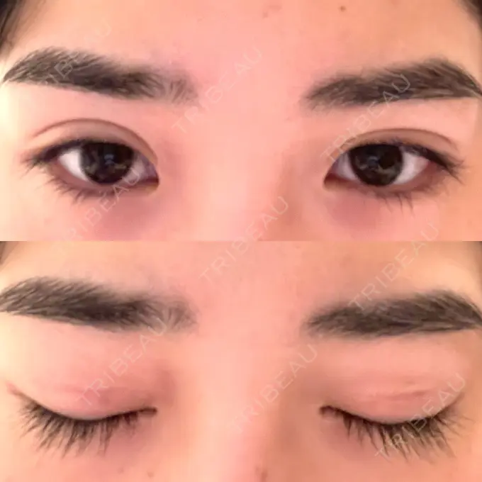 二重切開 高須クリニック 横浜院 AFTER メイン用