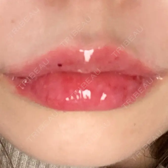 ヒアルロン酸注入（唇） YBC横浜美容外科 大宮院 DAY 0 メイン用