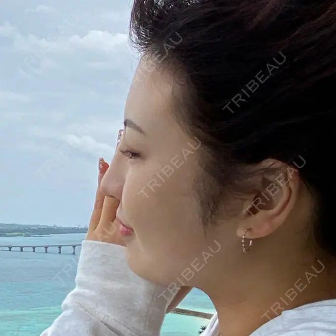 糸リフト / 脂肪吸引（顔） / その他（輪郭） TCB東京中央美容外科 八王子院 DAY 148 メイン用