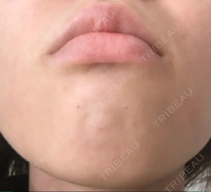 ボトックス（あご） TCB東京中央美容外科 新宿東口院 DAY 0 メイン用