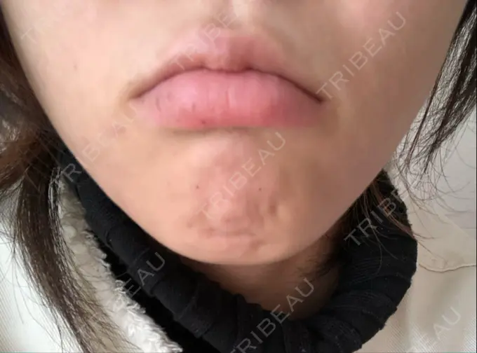 ボトックス（あご） TCB東京中央美容外科 新宿東口院 DAY 0 メイン用