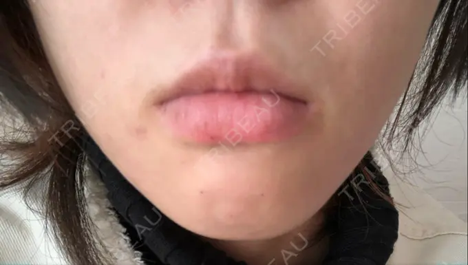 ボトックス（あご） TCB東京中央美容外科 新宿東口院 DAY 0 メイン用