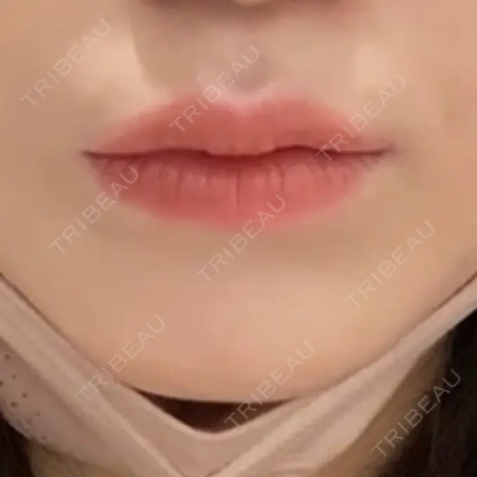 ヒアルロン酸注入（唇） / ボトックス（口角） ルラ美容クリニック 大宮院 / ルラスキンクリニック 大宮院 DAY 20 メイン用