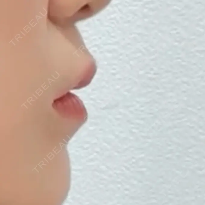 ヒアルロン酸注入（唇） / ボトックス（口角） ルラ美容クリニック 大宮院 / ルラスキンクリニック 大宮院 DAY 20 メイン用