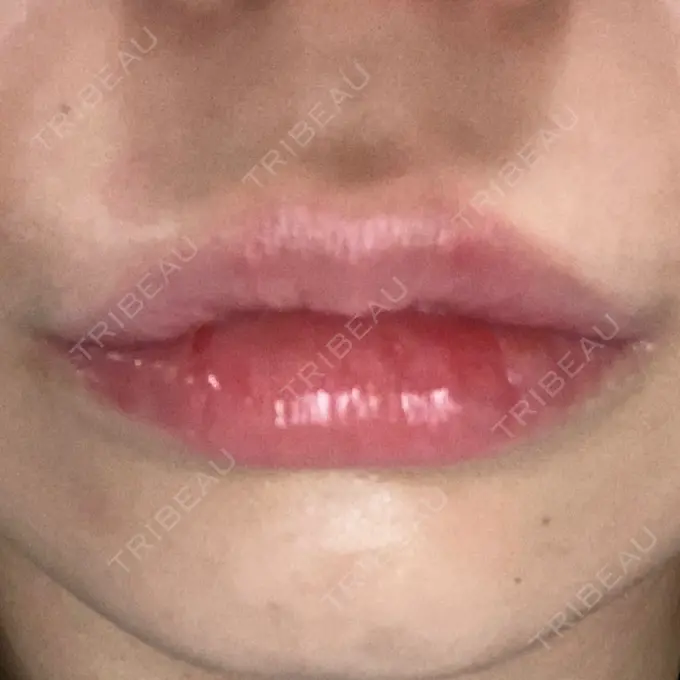 ヒアルロン酸注入（唇） YBC横浜美容外科 大宮院 DAY 1 メイン用