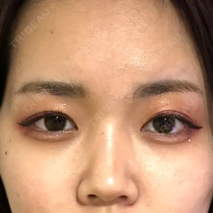 アートメイク（眉） 表参道ウィズ・クリニック DAY 6 メイン用