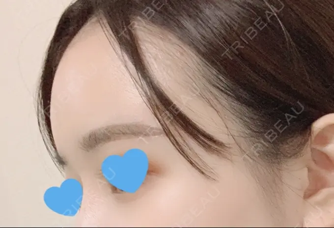 脂肪注入（額） / 脂肪注入（輪郭） スノウ（Snow）整形外科 AFTER メイン用