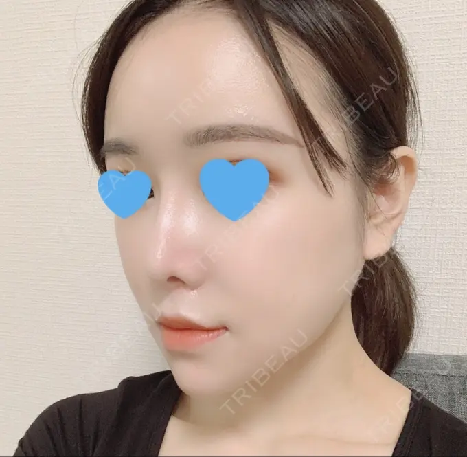 脂肪注入（額） / 脂肪注入（輪郭） スノウ（Snow）整形外科 DAY 27 メイン用