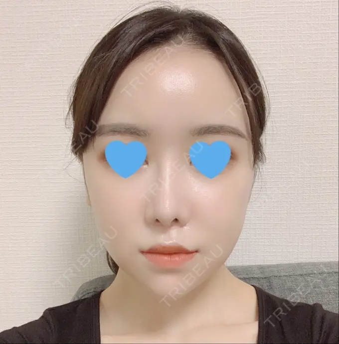 脂肪注入（額） / 脂肪注入（輪郭） スノウ（Snow）整形外科 DAY 27 メイン用