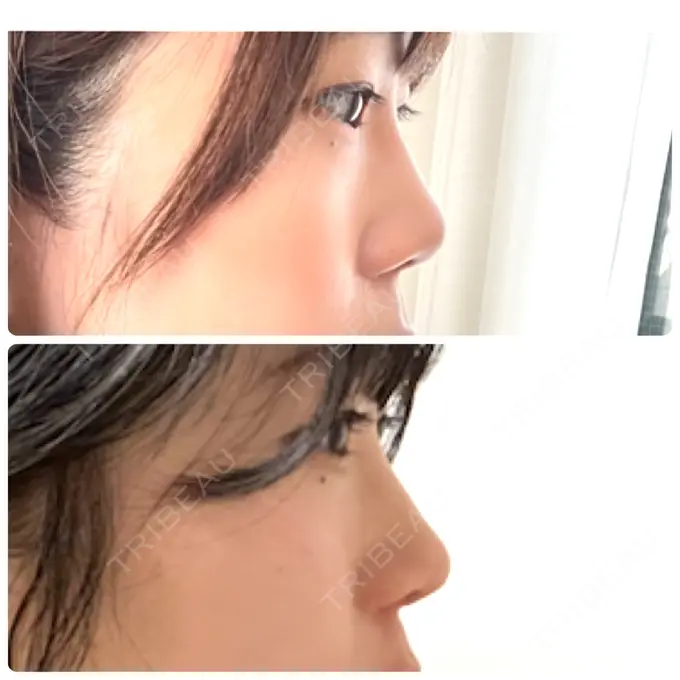 軟骨移植 / 鼻尖縮小 みずほクリニック DAY 21 メイン用