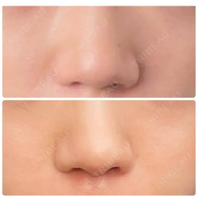軟骨移植 / 鼻尖縮小 みずほクリニック DAY 21 メイン用