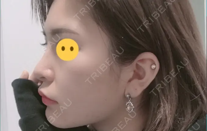 鼻尖形成（切開） / 鼻中隔延長（切開） / 軟骨移植 / プロテーゼ除去 / 鼻修正 / その他（鼻） FROM B整形外科 (旧バウム整形外科) AFTER メイン用