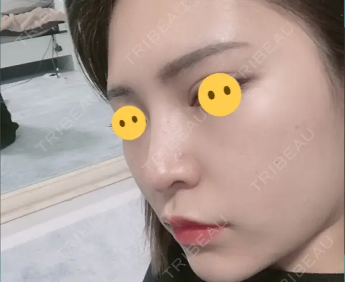 鼻尖形成（切開） / 鼻中隔延長（切開） / 軟骨移植 / プロテーゼ除去 / 鼻修正 / その他（鼻） FROM B整形外科 (旧バウム整形外科) DAY 307 メイン用