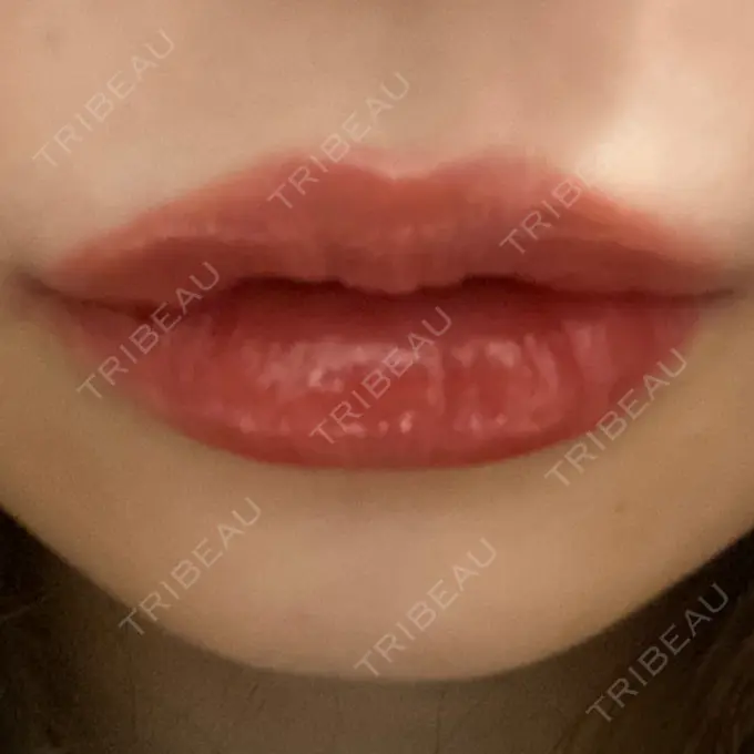 ヒアルロン酸注入（唇） YBC横浜美容外科 大宮院 AFTER メイン用