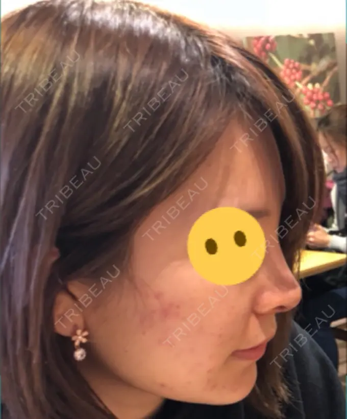 鼻尖形成（切開） / 鼻中隔延長（切開） / 軟骨移植 / プロテーゼ除去 / 鼻修正 / その他（鼻） FROM B整形外科 (旧バウム整形外科) DAY 5 メイン用