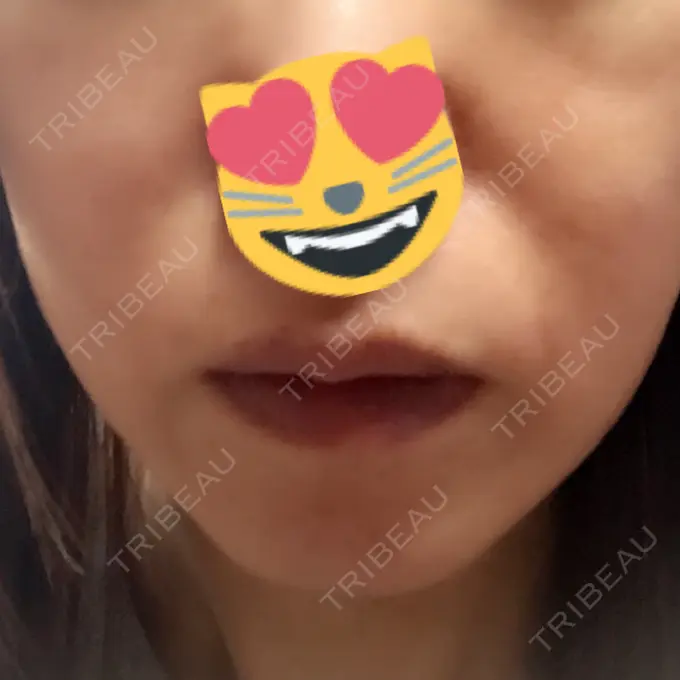 脂肪溶解注射（顔） 湘南美容クリニック 東京蒲田院 DAY 2 メイン用