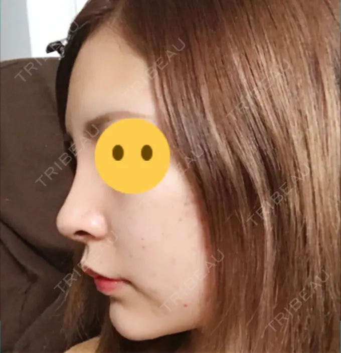 鼻尖形成（切開） / 鼻中隔延長（切開） / 軟骨移植 / プロテーゼ除去 / 鼻修正 / その他（鼻） FROM B整形外科 (旧バウム整形外科) DAY 8 メイン用