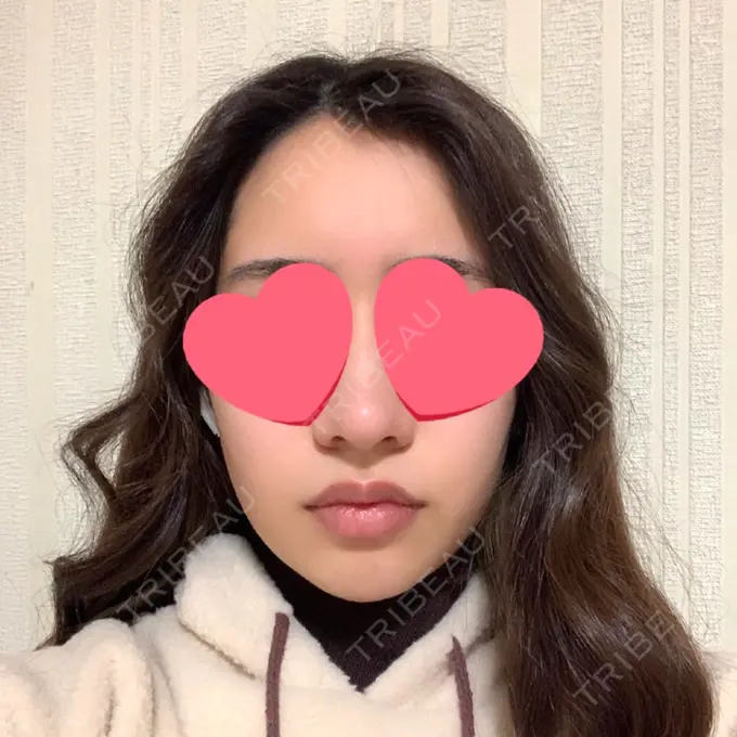 糸リフト / 脂肪吸引（顔） / メーラーファット除去 / ジョールファット除去 / ヒアルロン酸注入（頬） SEA CLINIC（シークリニック） DAY 57 メイン用