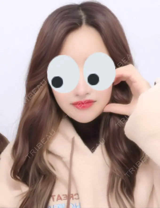 糸リフト / 脂肪吸引（顔） / メーラーファット除去 / ジョールファット除去 / ヒアルロン酸注入（頬） SEA CLINIC（シークリニック） DAY 57 メイン用